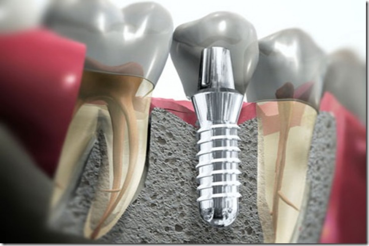 Implantes Dent&aacute;rios